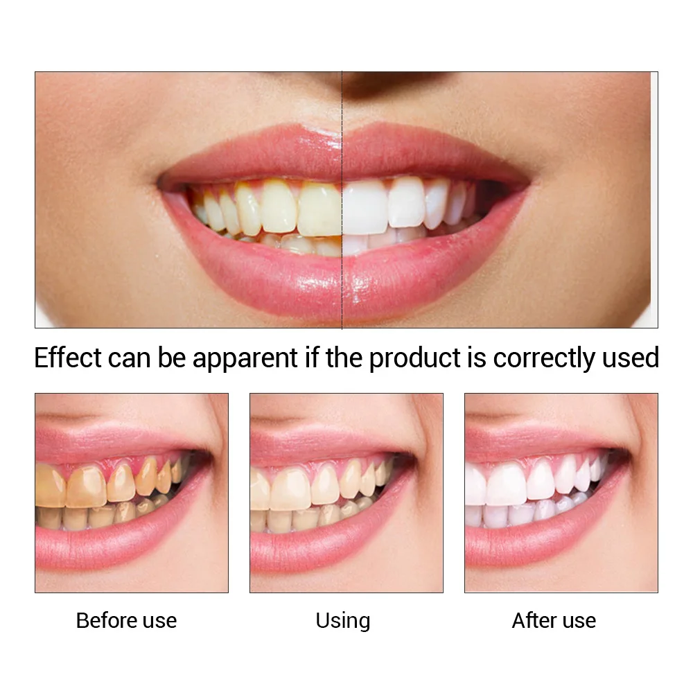 FTEENPLY Zahnaufhellung Essenz – Teeth Whitening Lab Bewertung und Preis