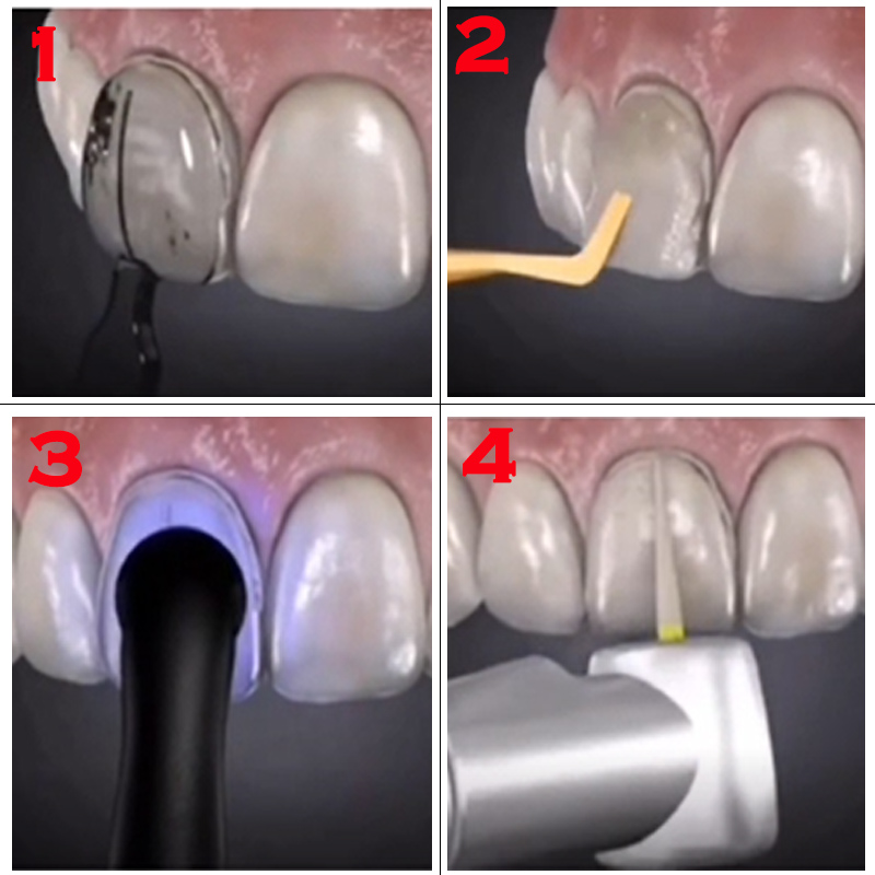 Zahnform für Komposit-Harz-Ven – Teeth Whitening Lab Bewertung und Preis