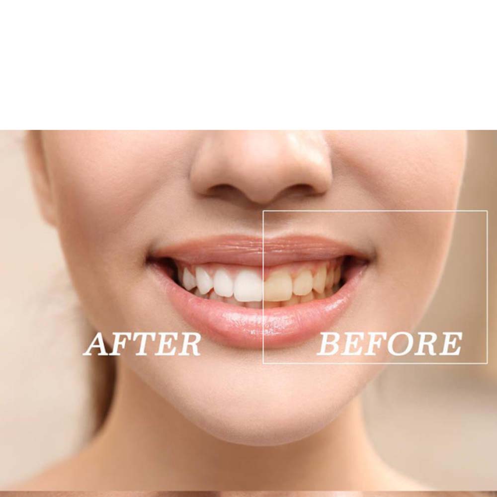 Hochwertiges Peroxid-Zahnaufhe – Teeth Whitening Kit Bewertung und Preis